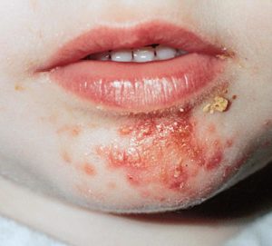 tn_94a9724ea8_impetigo