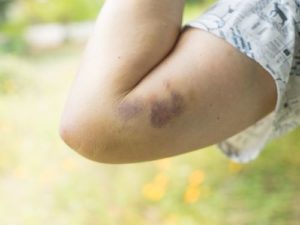 hematomas-que-surgem-de-forma-espontanea-podem-ser-sinal-de-que-algo-esta-errado-com-seu-organismo-3