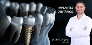 Implantes Dentários