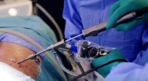 HONPAR é referência em cirurgias de coluna com o uso de aparelho de endoscopia