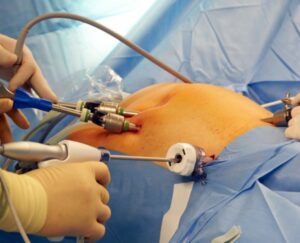 Para quem a cirurgia bariátrica é indicada?