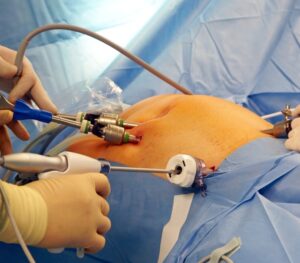 Pacientes que passaram por cirurgia bariátrica podem ter reganho de peso, mas existe tratamento para voltar a perde peso