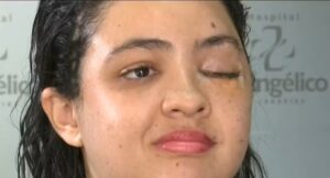 Titânio em cirurgias: entenda como o metal ajudou na inédita reconstrução de face da mulher atropelada por colheitadeira no Paraná